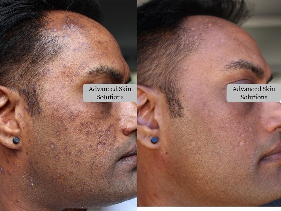 hyperpigmentation face before and after